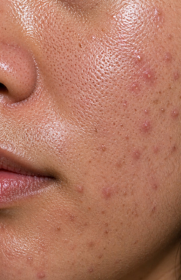 Oily Skin + Acne+Open Pores